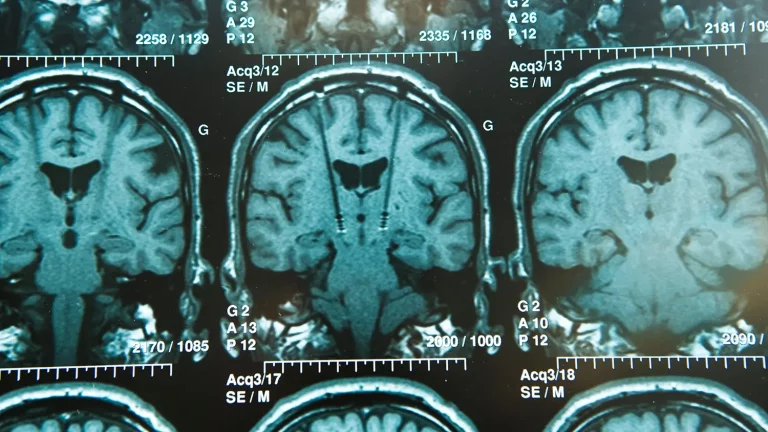 Collaboration SCP et AMPS pour le traitement de Parkinson